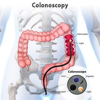 colonoscopy-s1-what-is-colonoscopy-illustration.jpg